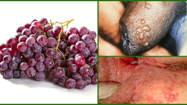 Alternativa de tratamiento: famciclovir para el herpes z&oacute;ster