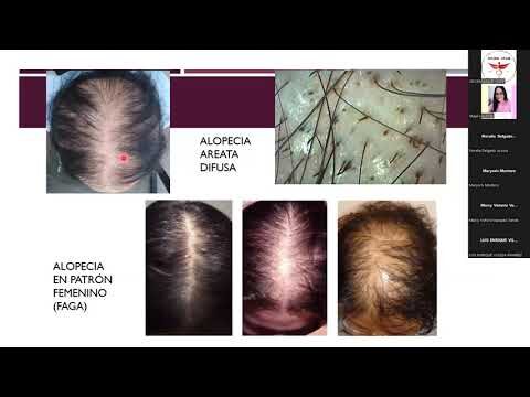 La evoluci&oacute;n f&iacute;sica con finasterida: un an&aacute;lisis conciso