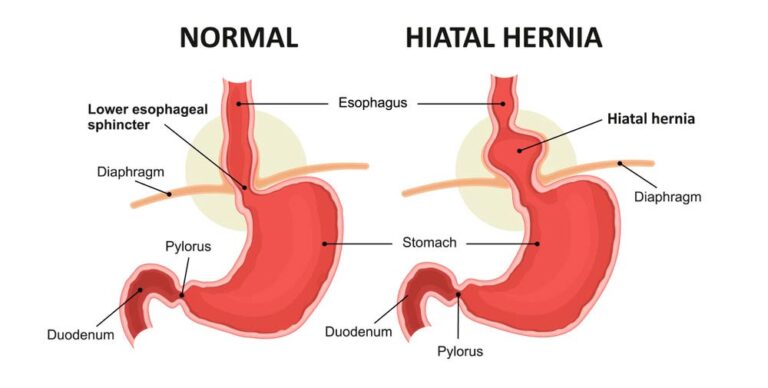 Alivio de síntomas de hernia de hiato con roxatidina
