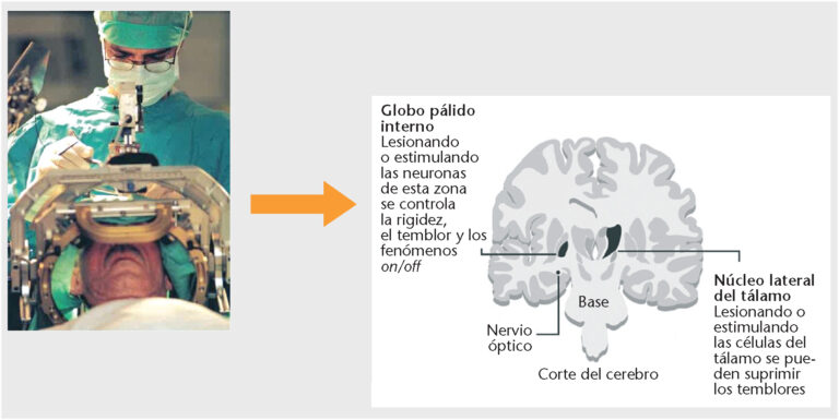 Entacapona: Contribuci&oacute;n al tratamiento de trastornos de movimiento