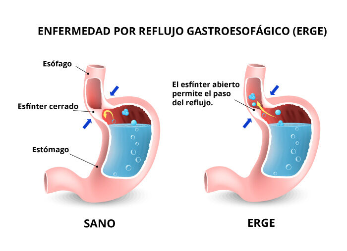 Roxatidina: efectividad en el reflujo gástrico