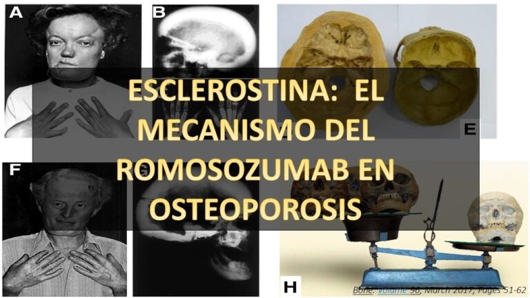 Alendronato: clave para la densidad ósea