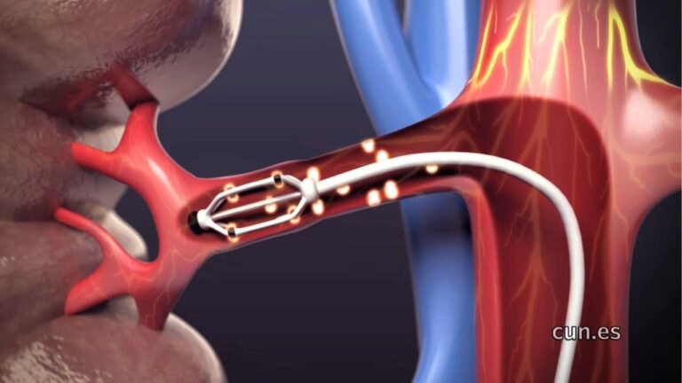 Espironolactona para hipertensión resistente