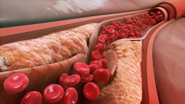 Opciones Efectivas para el Control del Colesterol