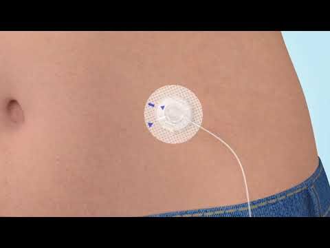 Innovación en Sistemas de Administración de Insulina: Bombas Efectivas para el Control Glucémico