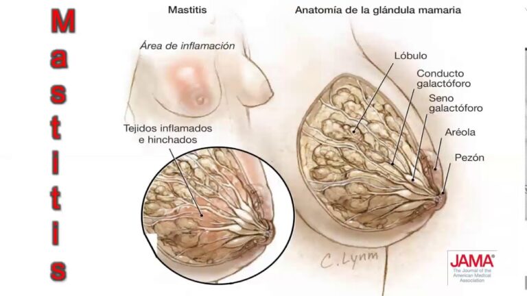 Efectos de la Domperidona en la Lactancia Materna