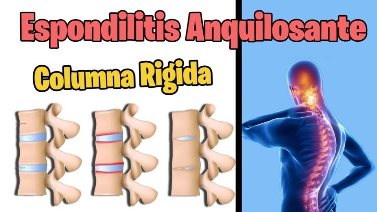 Eficacia del Tratamiento con Diclofenaco en la Espondilitis Anquilosante